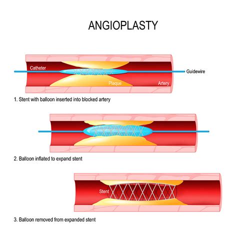 pci types|pci medical abbreviation.